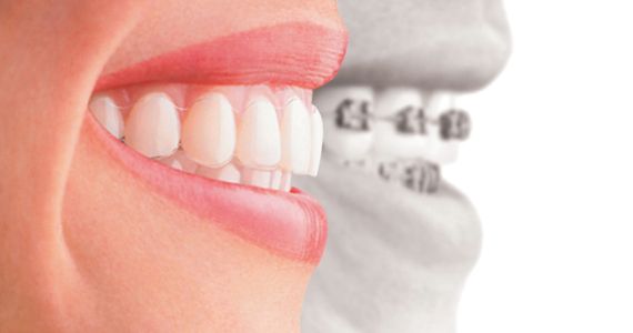 hyattsville Dentist Invisalign Smile
